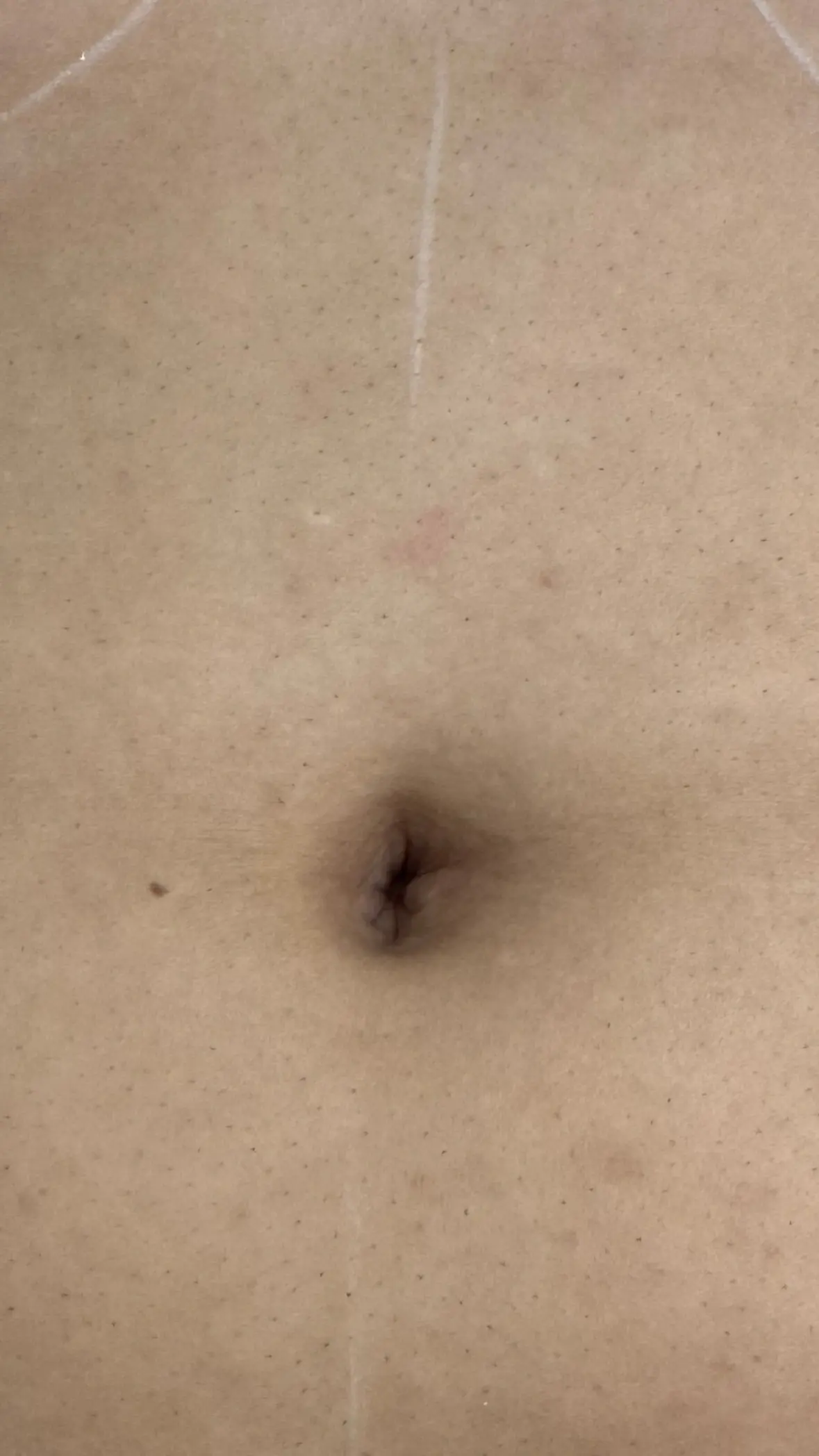 Abdomen after laser hair removal treatment