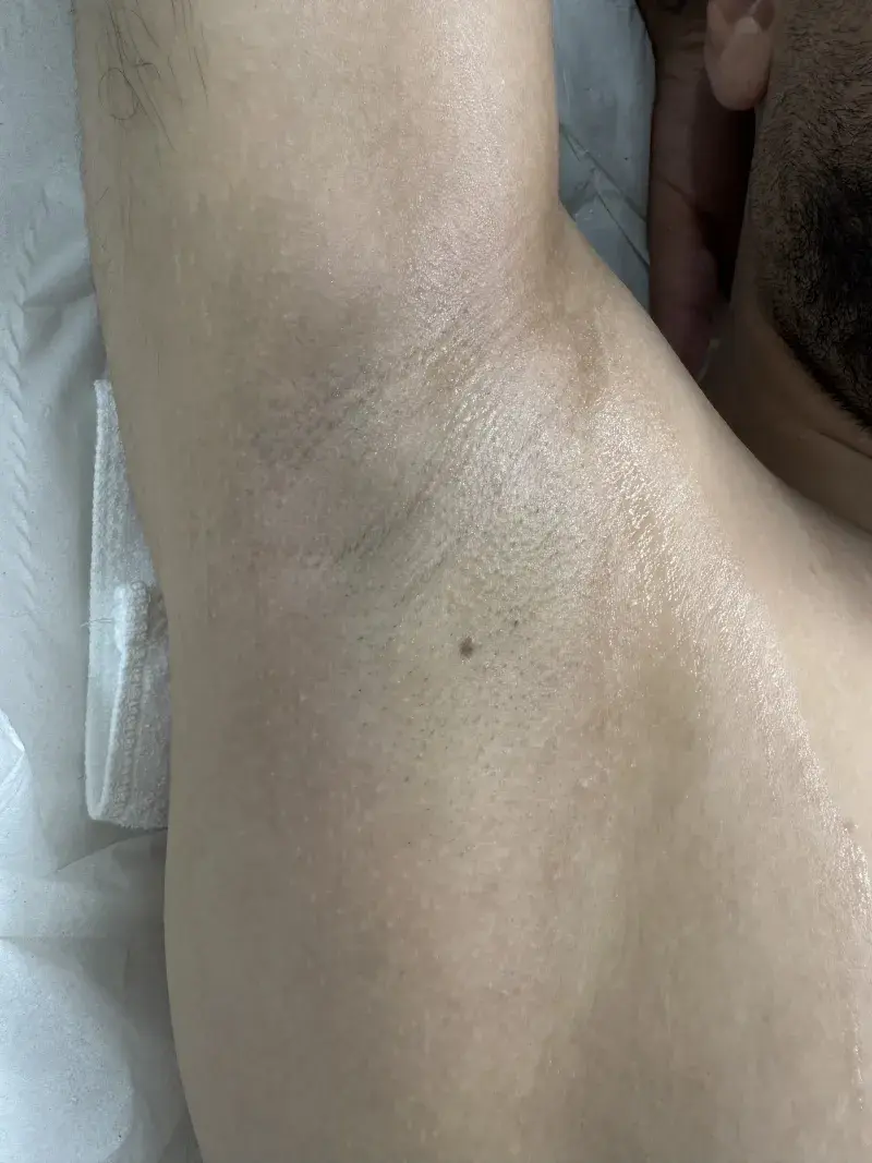 Underarms after laser hair removal treatment