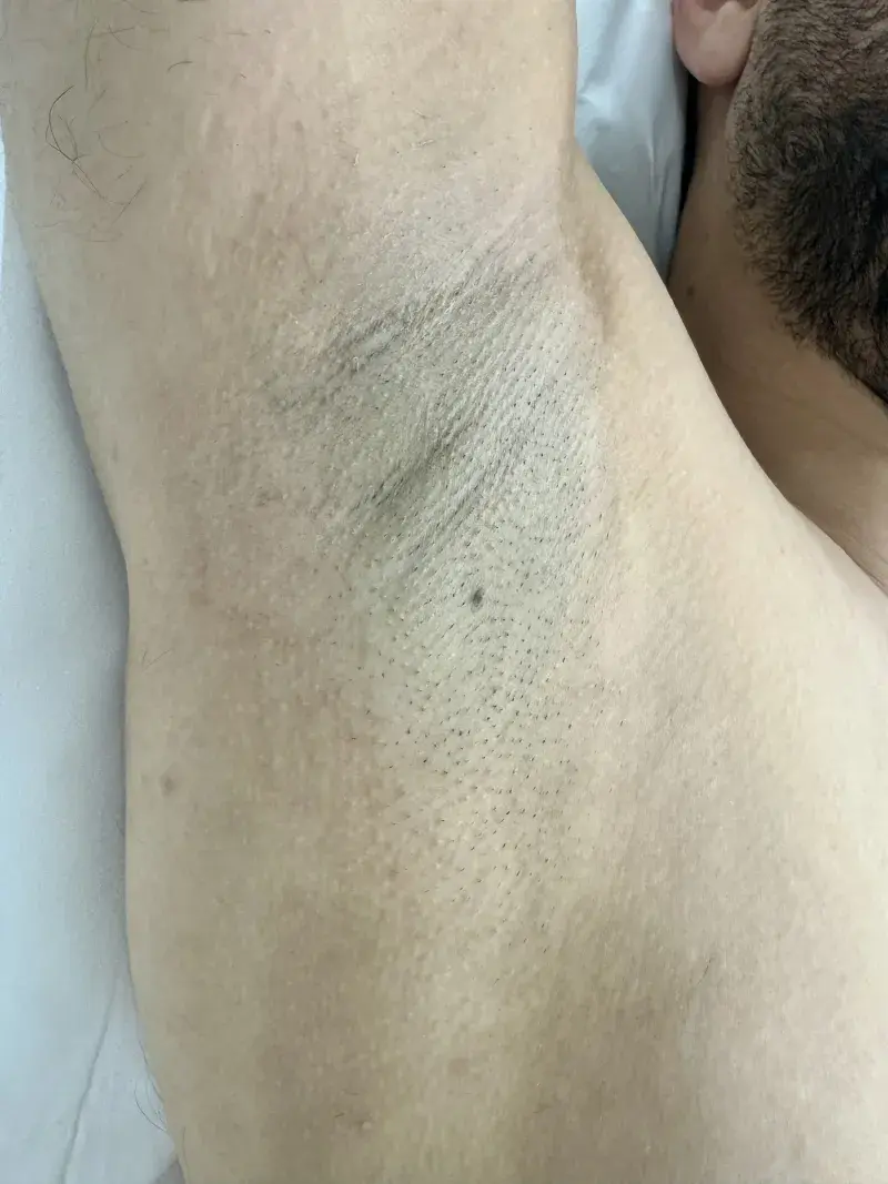 Underarms before laser hair removal treatment